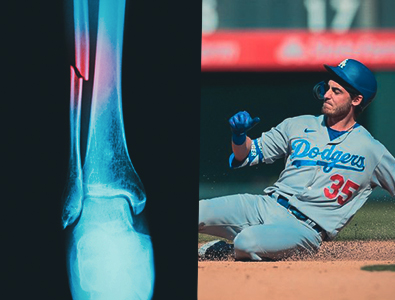 Cody Bellinger, do Los Angeles Dodgers, sofreu uma pequena fratura na fíbula.